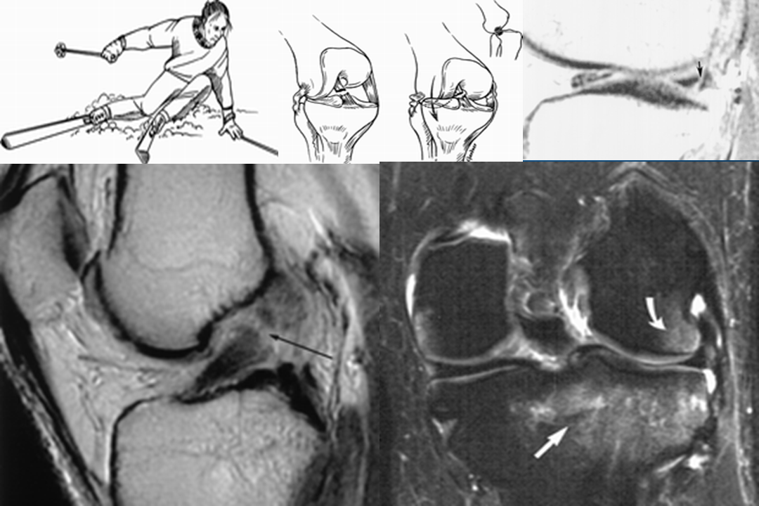膝关节韧带损伤的MR诊断