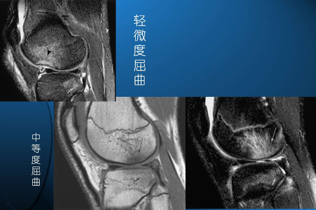 膝关节韧带损伤的MR诊断