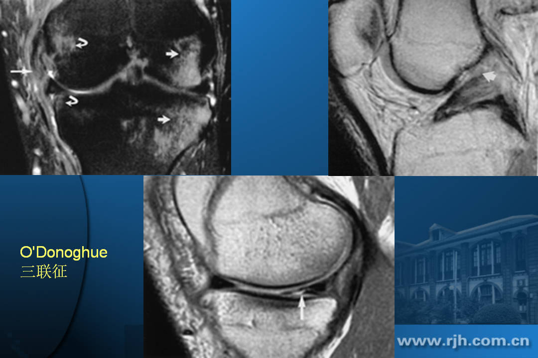 膝关节韧带损伤的MR诊断