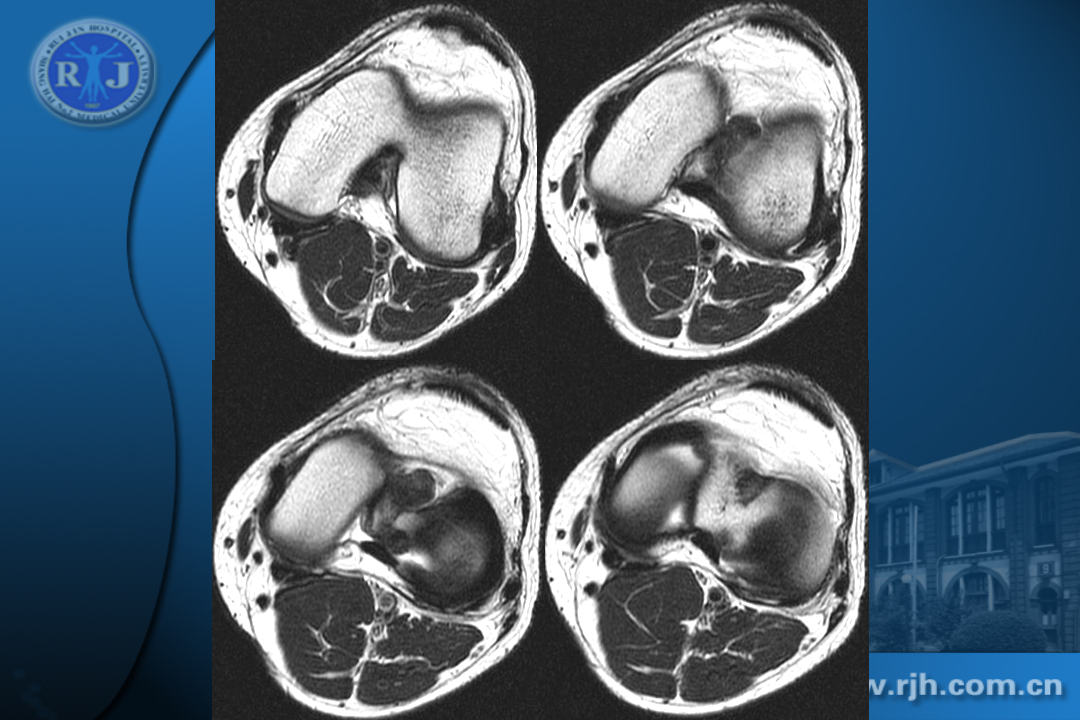 膝关节韧带损伤的MR诊断
