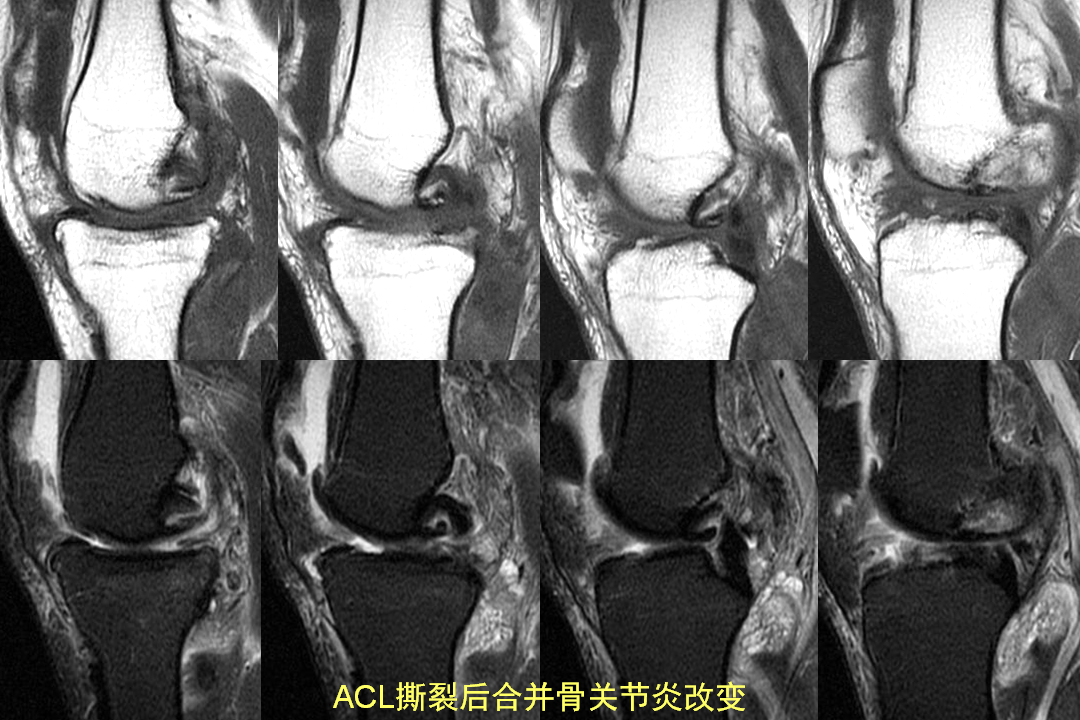 膝关节韧带损伤的MR诊断