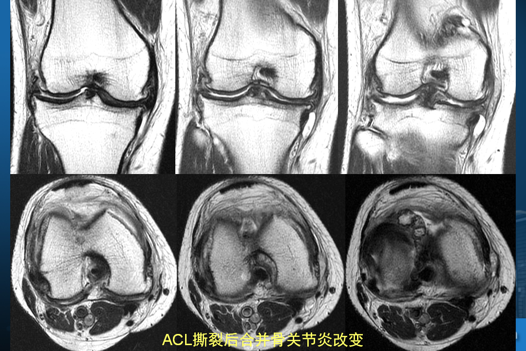 膝关节韧带损伤的MR诊断
