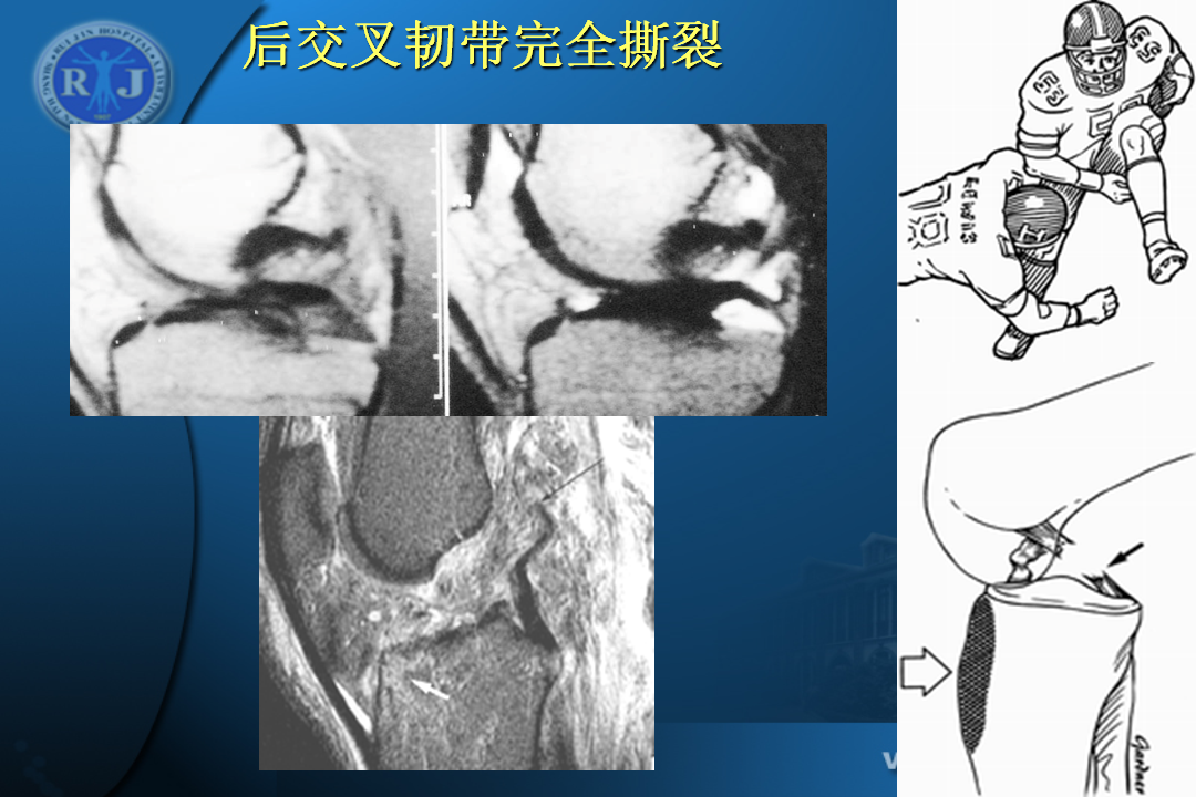 膝关节韧带损伤的MR诊断