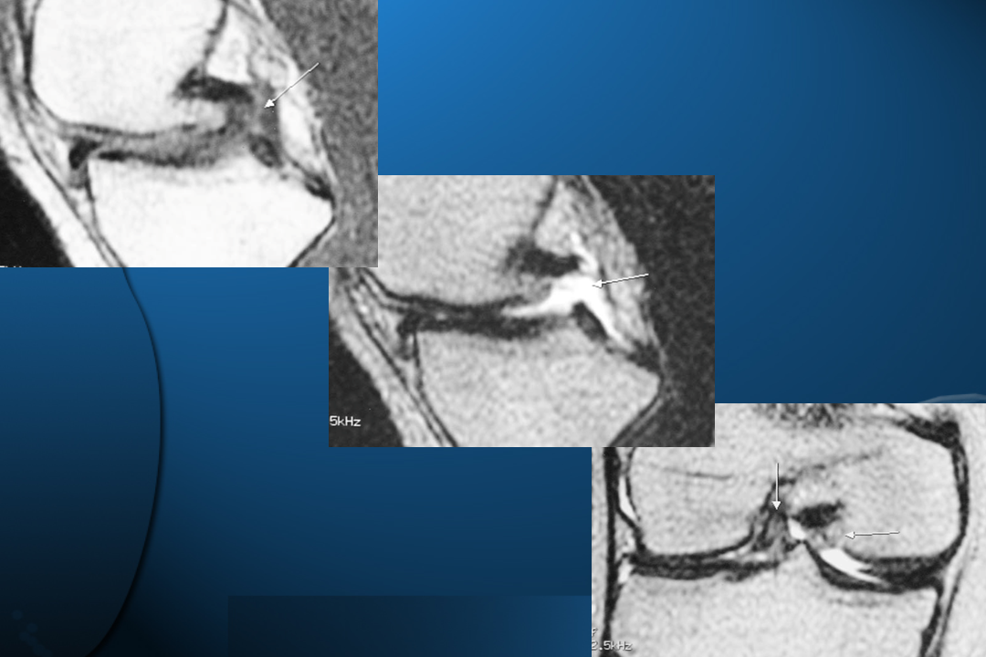 膝关节韧带损伤的MR诊断
