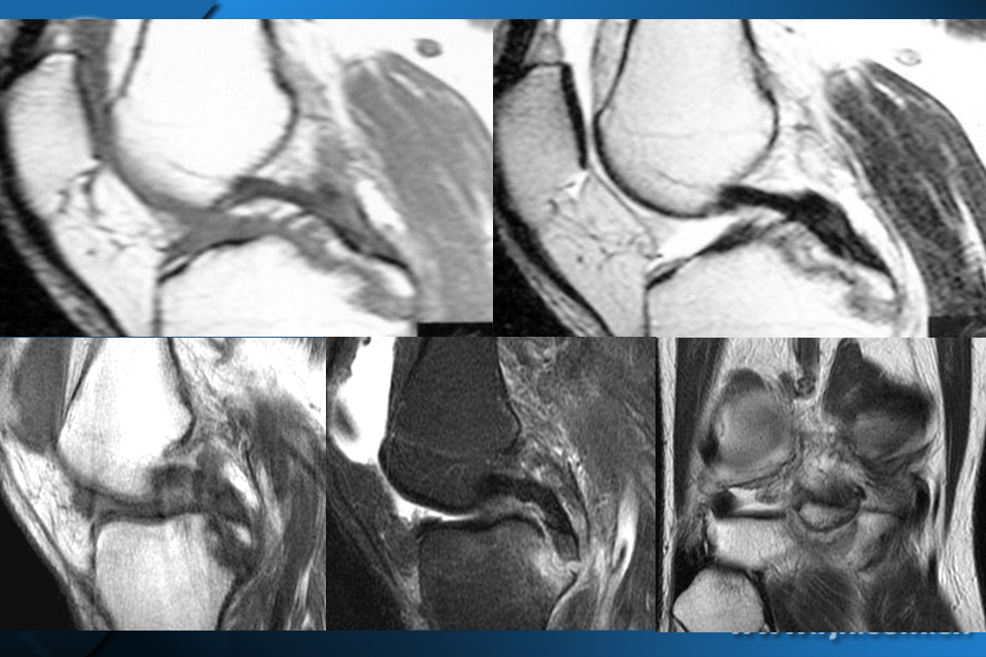 膝关节韧带损伤的MR诊断