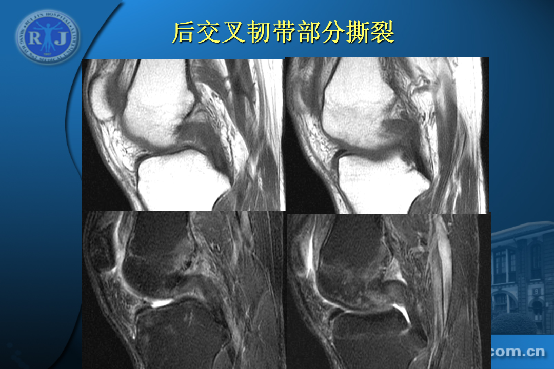 膝关节韧带损伤的MR诊断