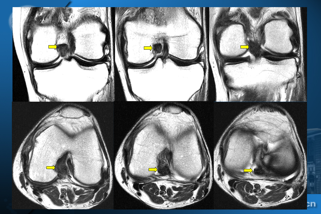膝关节韧带损伤的MR诊断