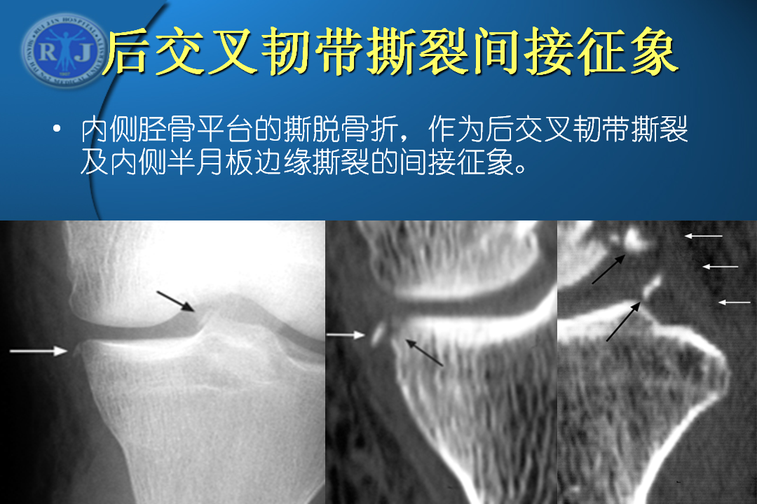 膝关节韧带损伤的MR诊断