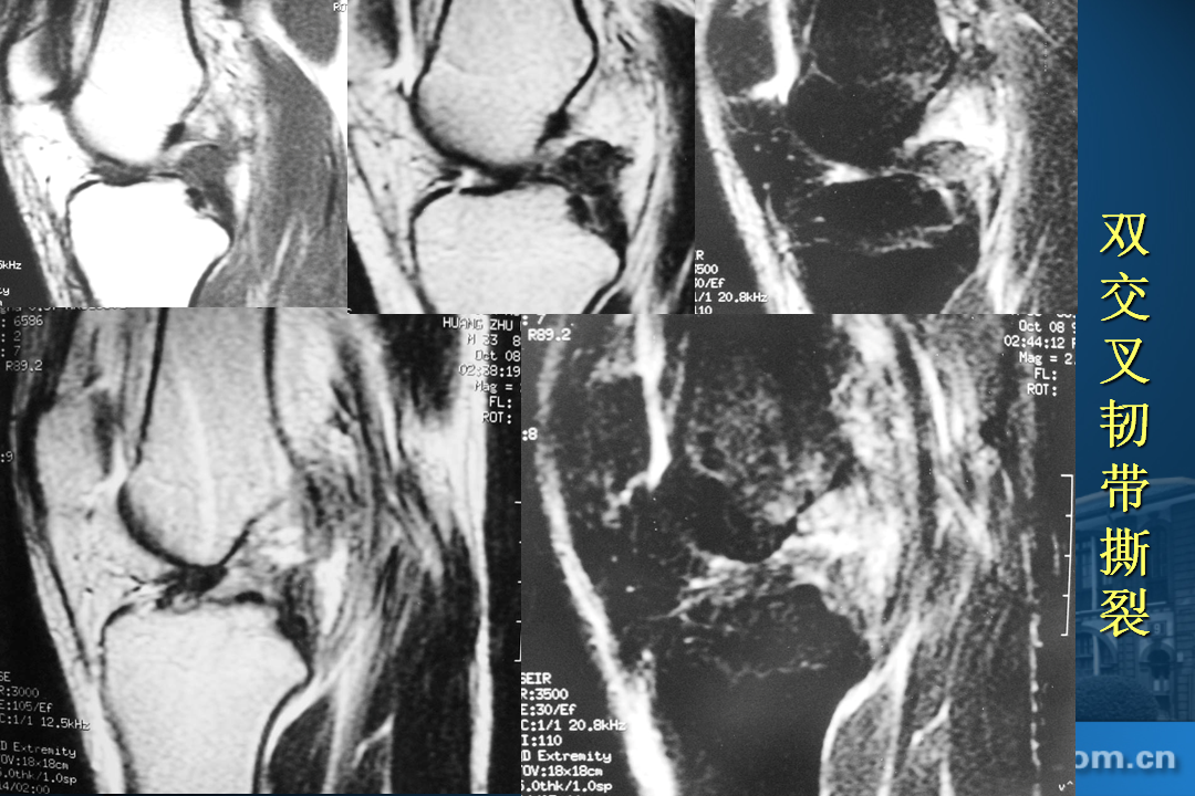 膝关节韧带损伤的MR诊断