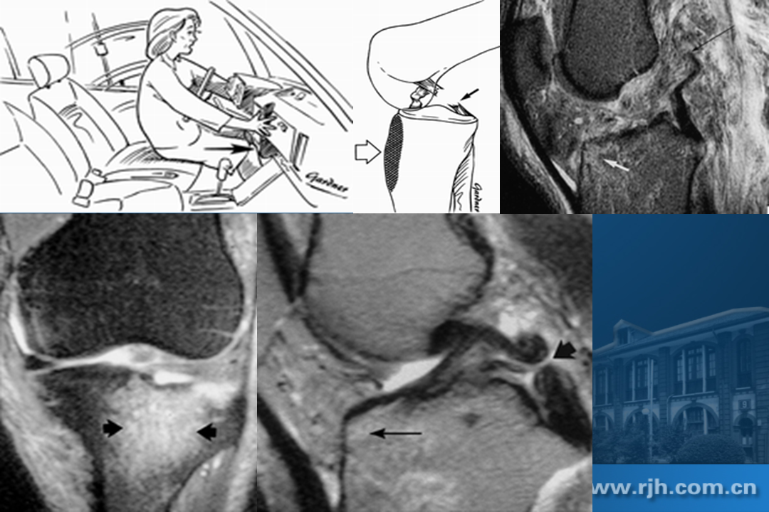 膝关节韧带损伤的MR诊断