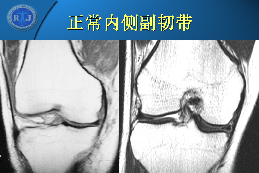 膝关节韧带损伤的MR诊断