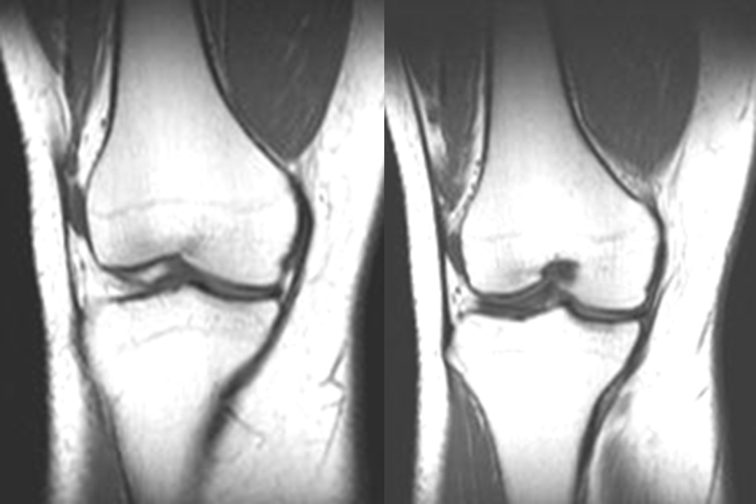膝关节韧带损伤的MR诊断