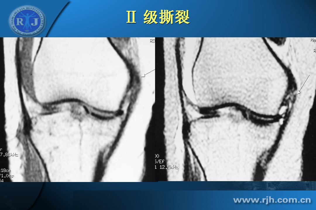 膝关节韧带损伤的MR诊断