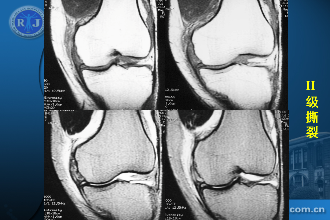 膝关节韧带损伤的MR诊断