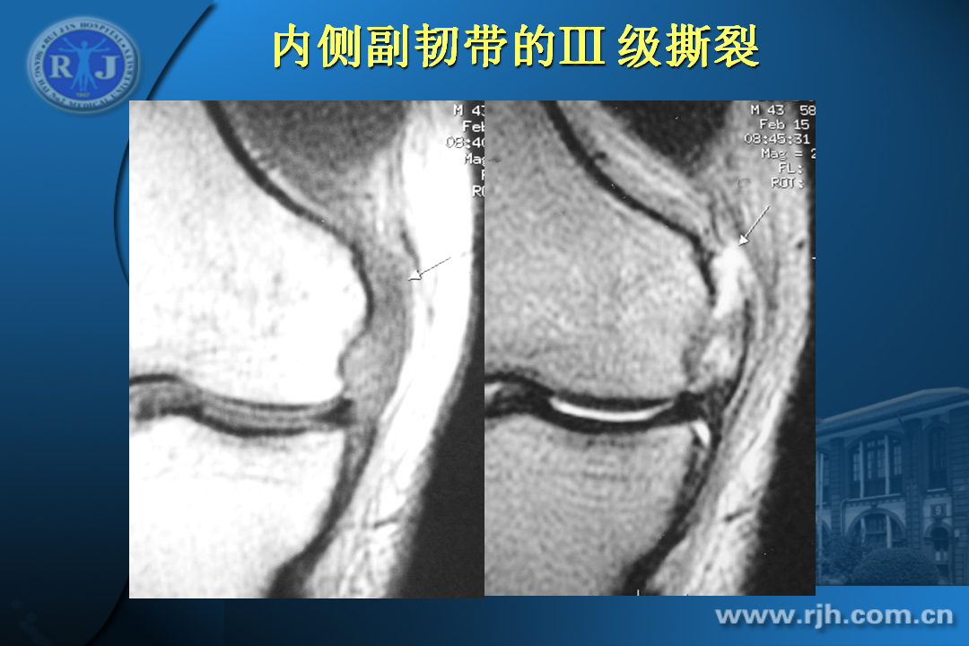 膝关节韧带损伤的MR诊断