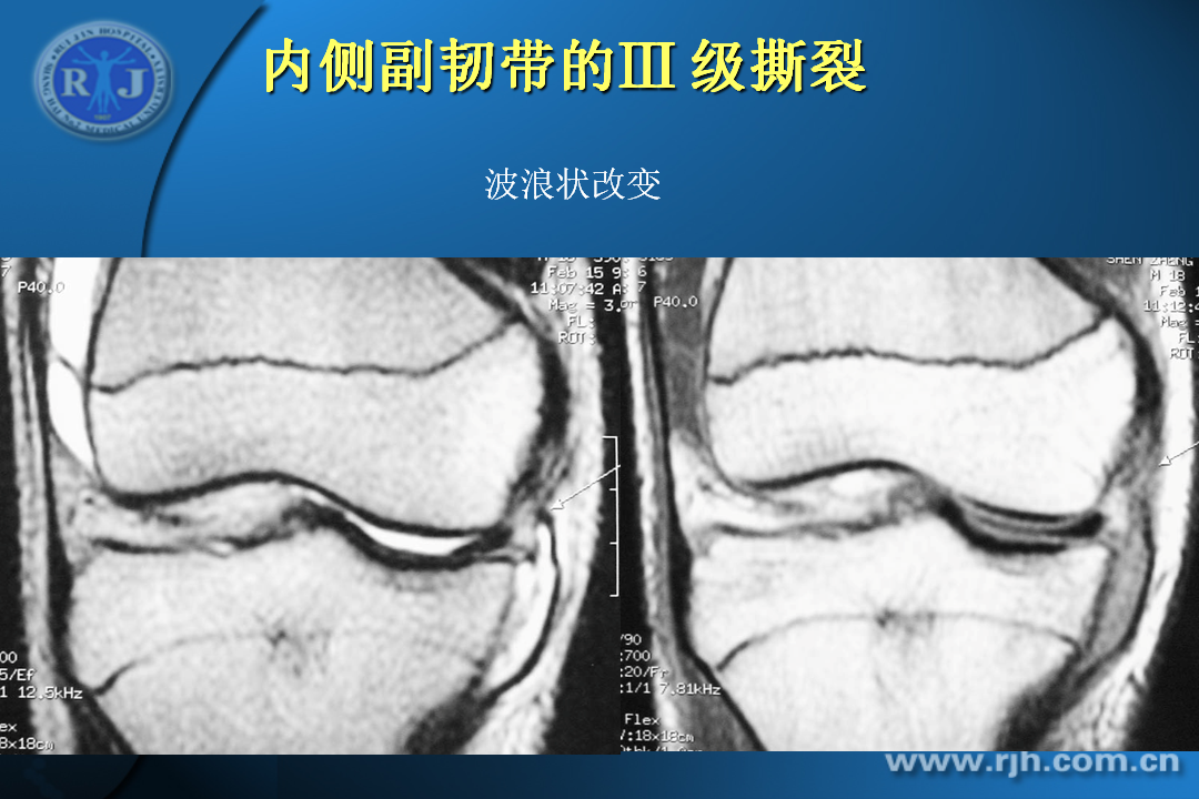 膝关节韧带损伤的MR诊断