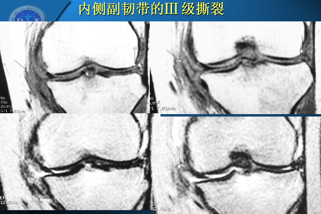 膝关节韧带损伤的MR诊断