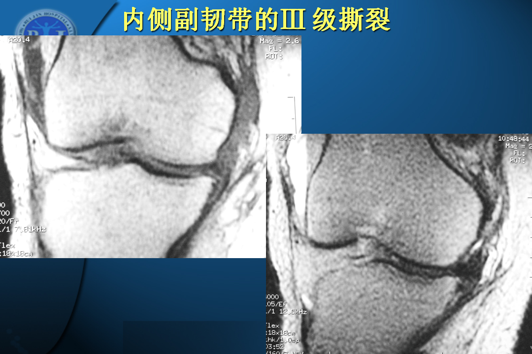 膝关节韧带损伤的MR诊断