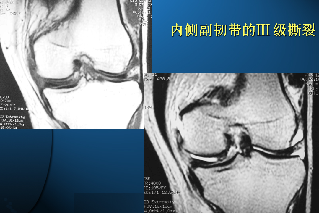 膝关节韧带损伤的MR诊断