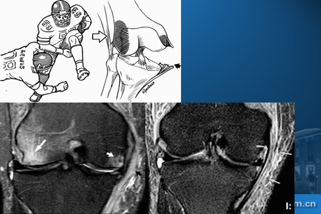 膝关节韧带损伤的MR诊断