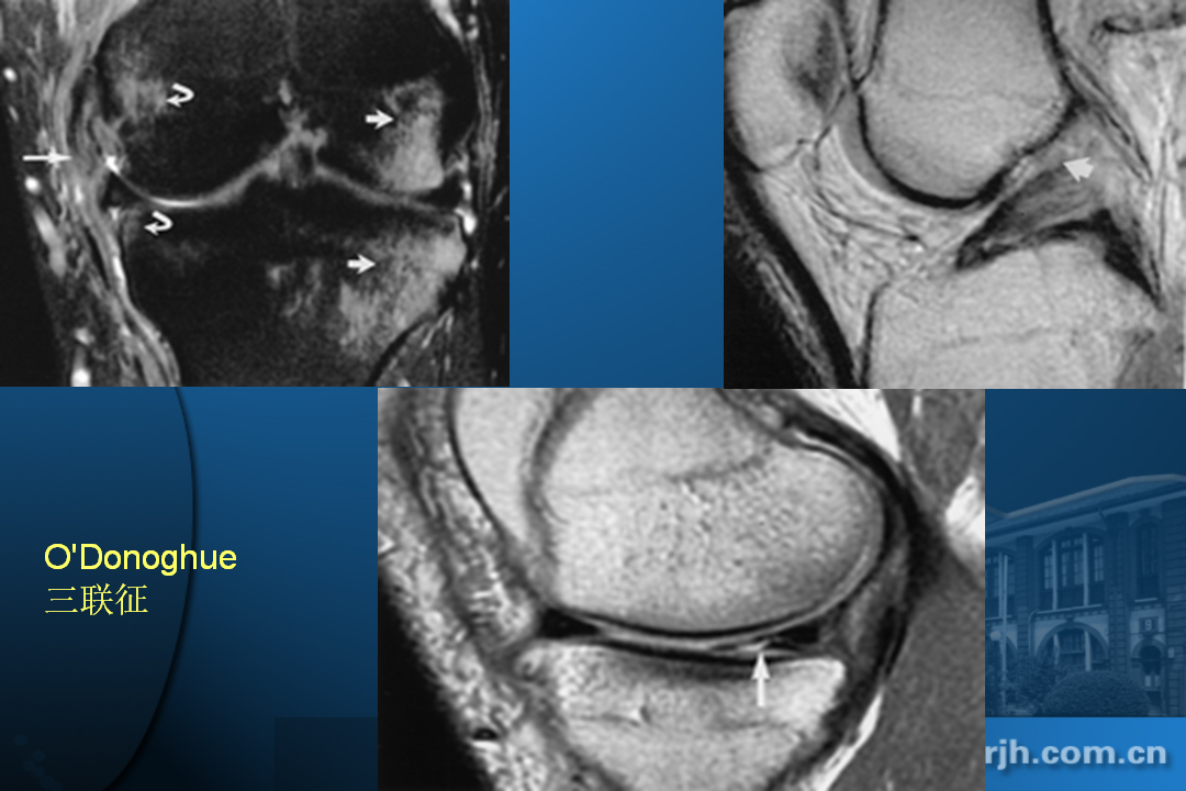 膝关节韧带损伤的MR诊断