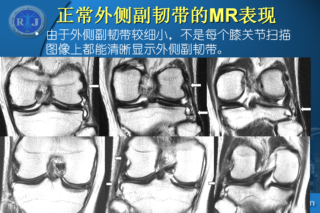 膝关节韧带损伤的MR诊断