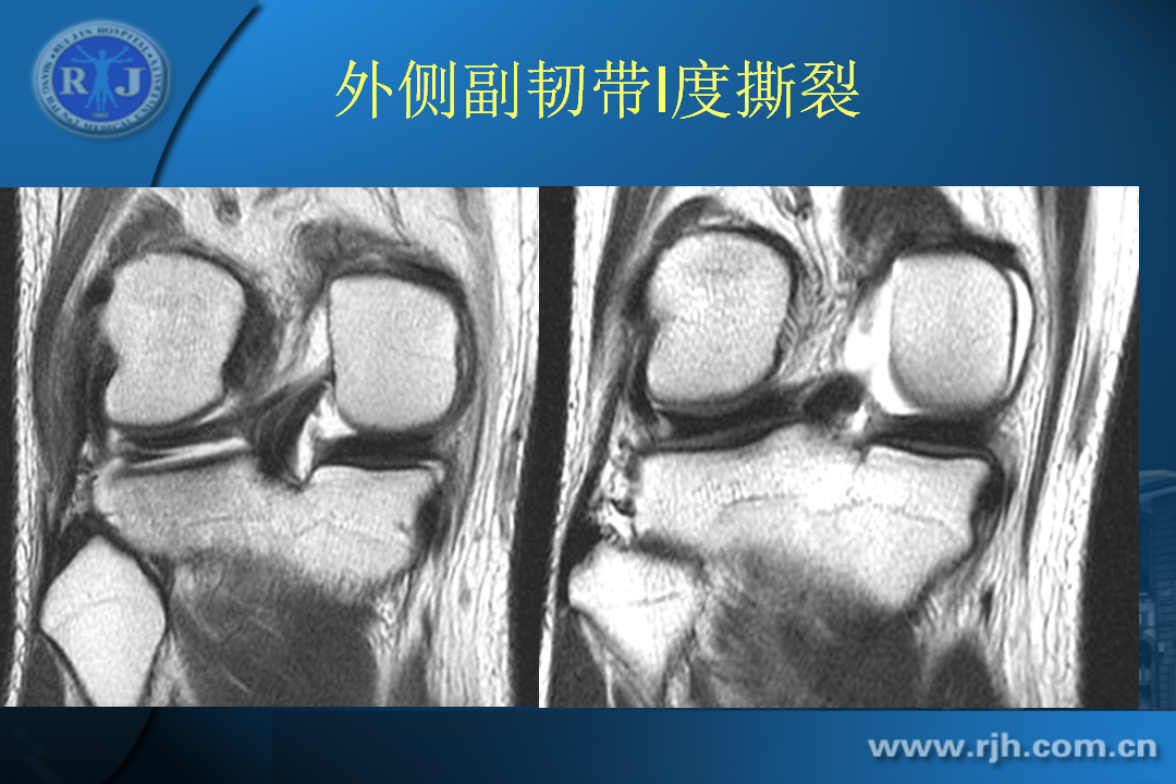 膝关节韧带损伤的MR诊断