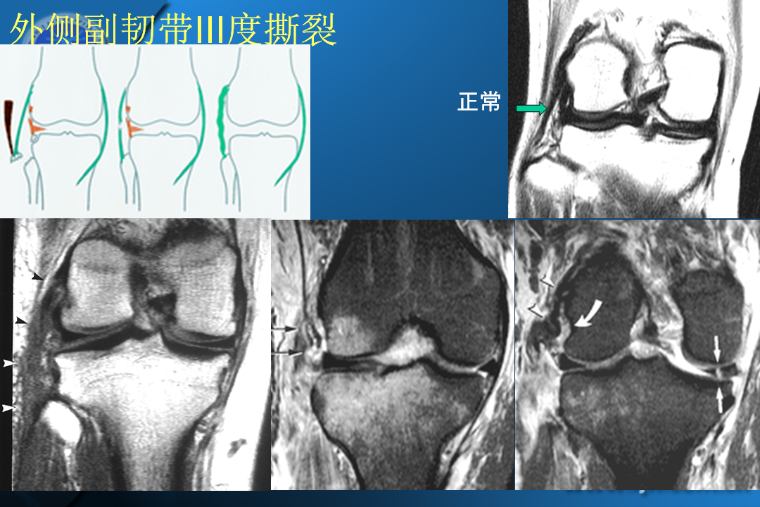 膝关节韧带损伤的MR诊断