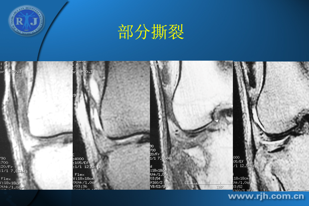 膝关节韧带损伤的MR诊断