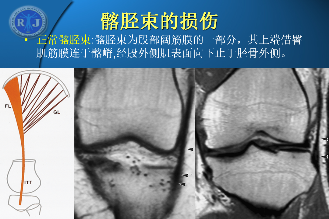 膝关节韧带损伤的MR诊断