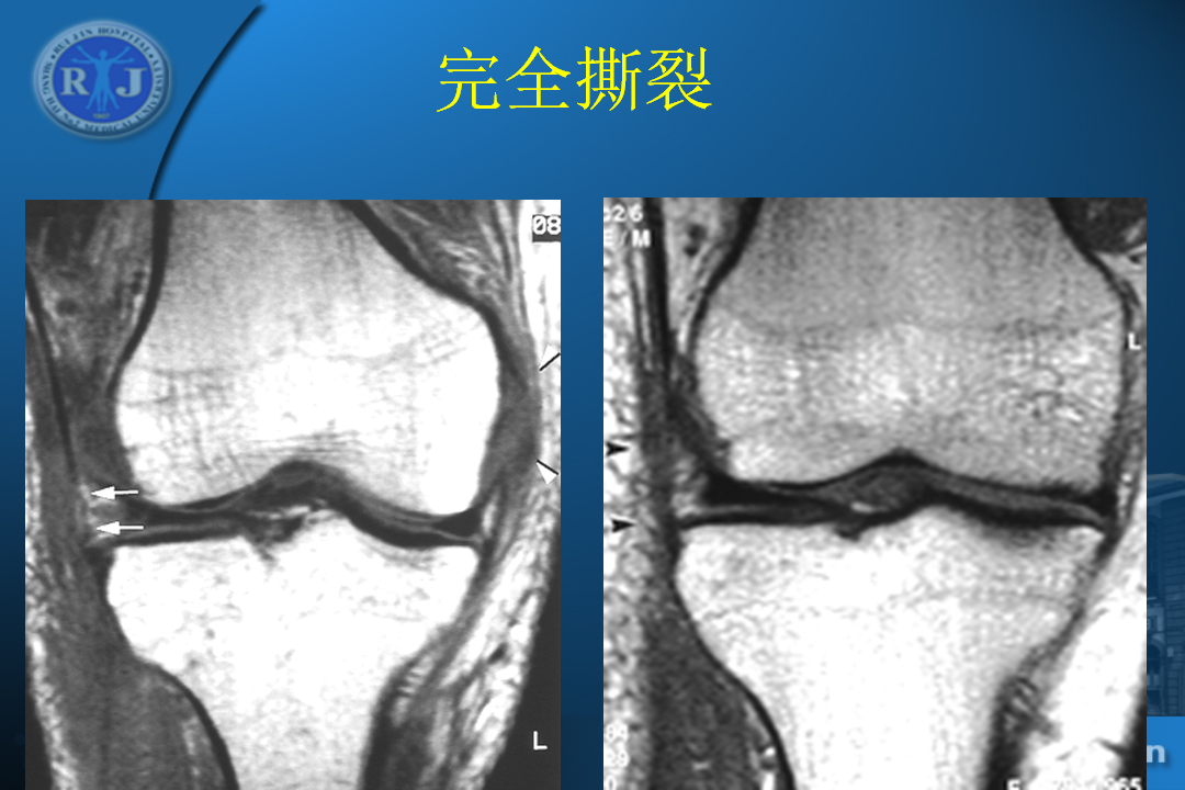 膝关节韧带损伤的MR诊断