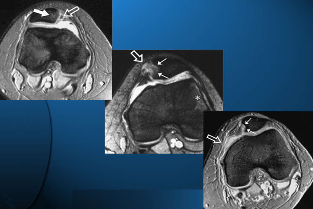 膝关节韧带损伤的MR诊断