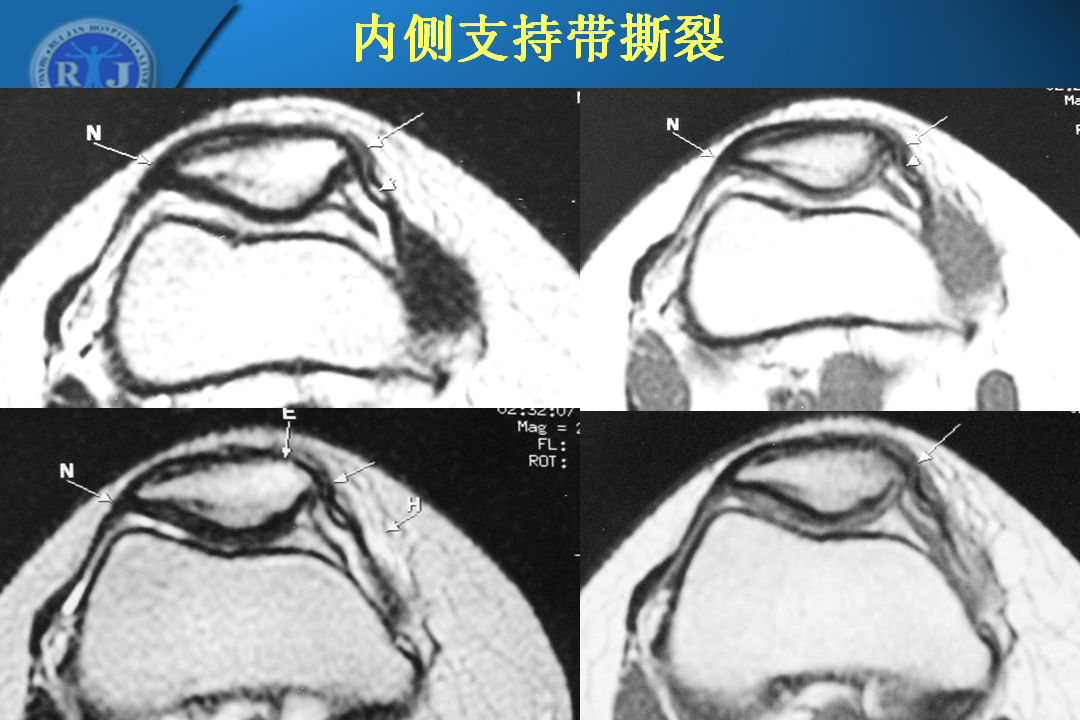 膝关节韧带损伤的MR诊断