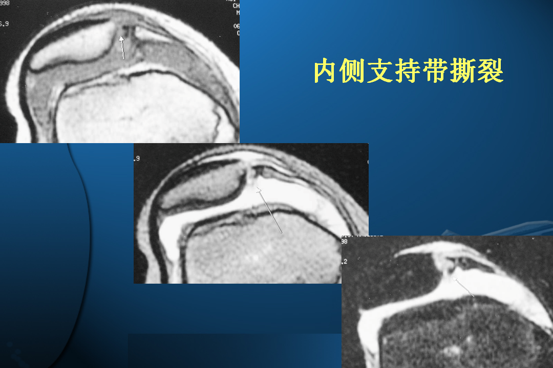 膝关节韧带损伤的MR诊断