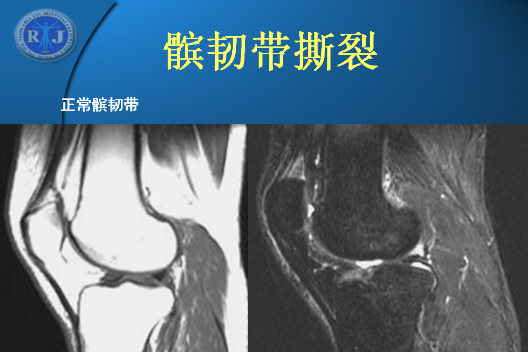 膝关节韧带损伤的MR诊断