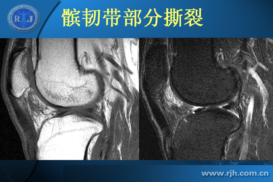 膝关节韧带损伤的MR诊断