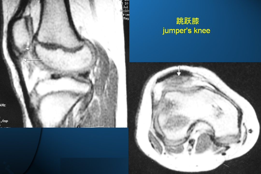 膝关节韧带损伤的MR诊断