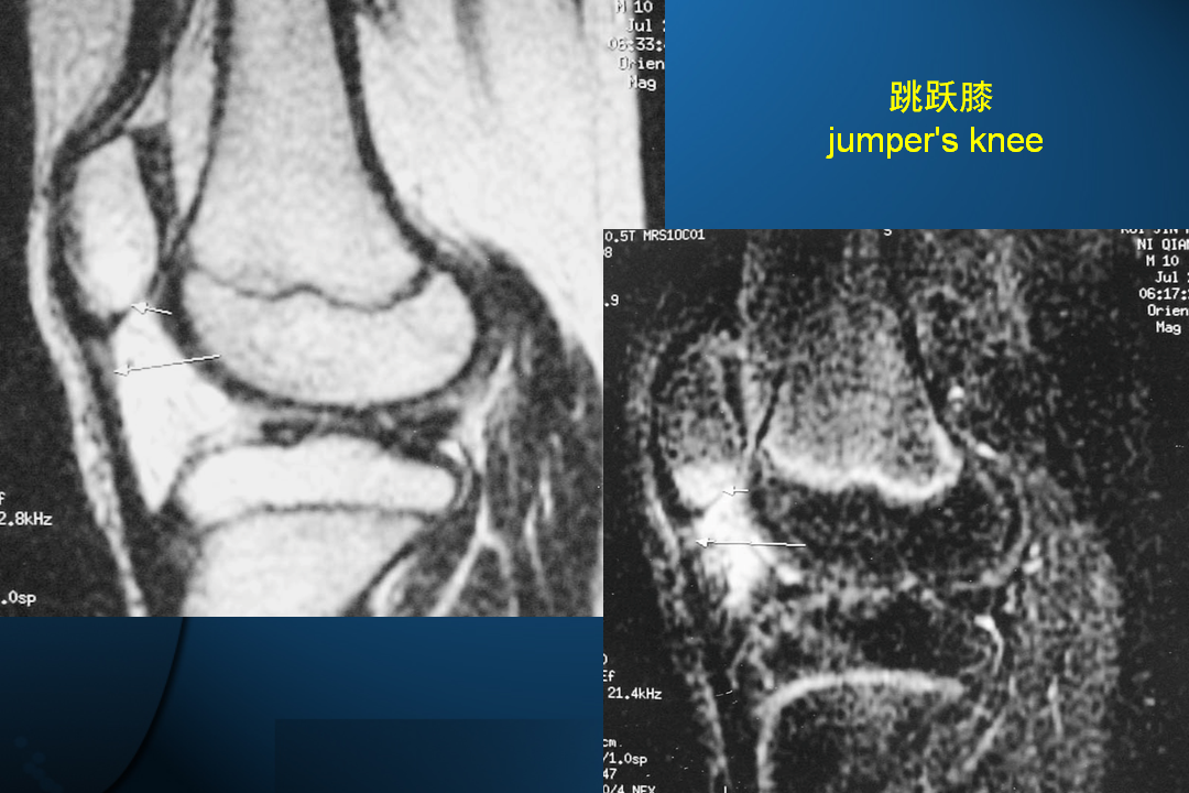 膝关节韧带损伤的MR诊断
