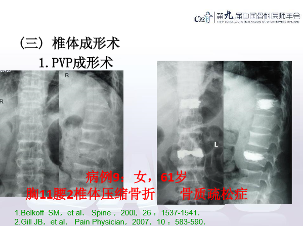 胸腰椎椎体成形术手术技巧