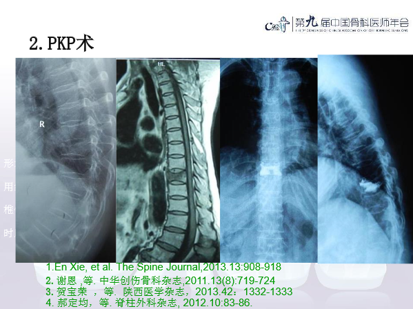 胸腰椎椎体成形术手术技巧