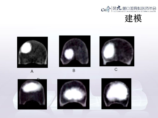 胸腰椎椎体成形术手术技巧