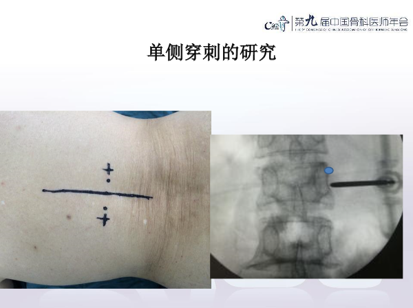 胸腰椎椎体成形术手术技巧