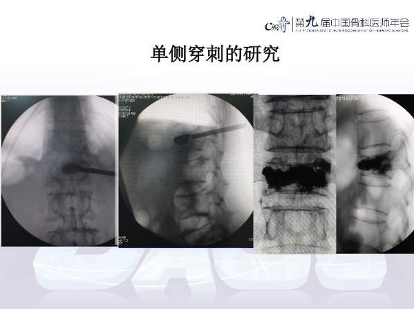 胸腰椎椎体成形术手术技巧