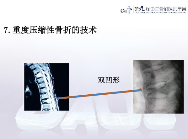 胸腰椎椎体成形术手术技巧