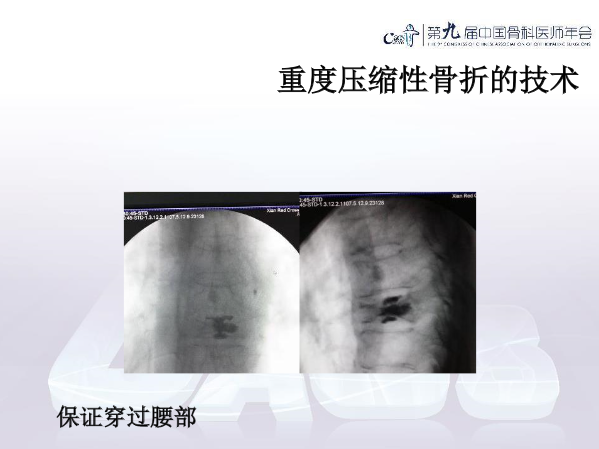 胸腰椎椎体成形术手术技巧