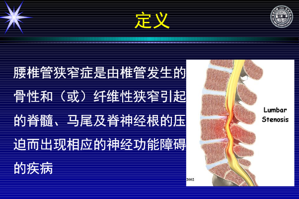 怎样判定腰椎管狭窄症的手术责任椎？