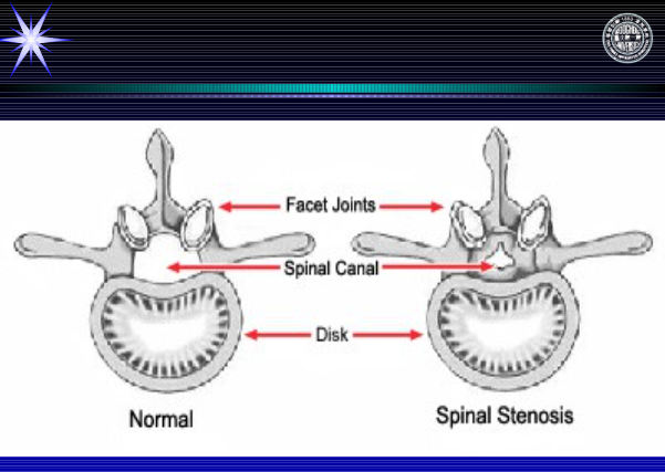怎样判定腰椎管狭窄症的手术责任椎？