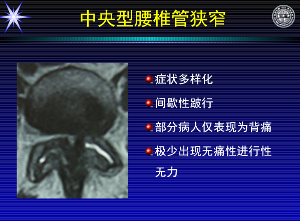 怎样判定腰椎管狭窄症的手术责任椎？