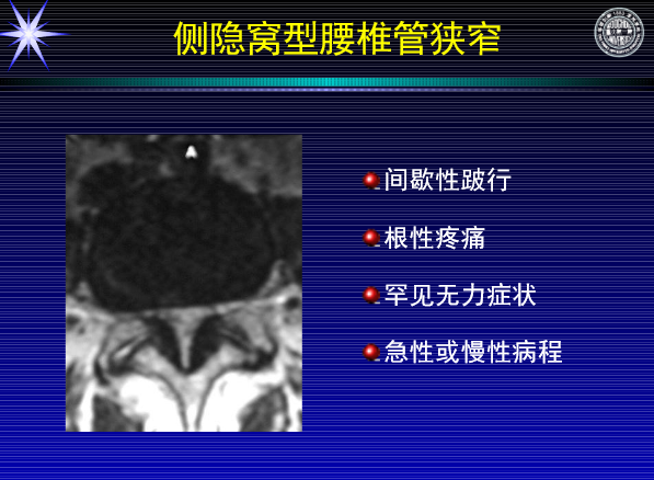 怎样判定腰椎管狭窄症的手术责任椎？