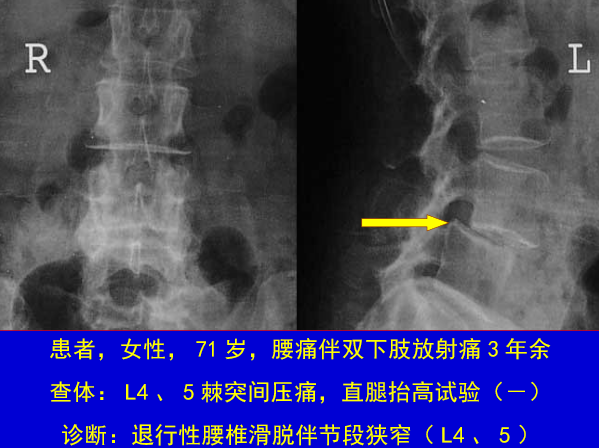 怎样判定腰椎管狭窄症的手术责任椎？